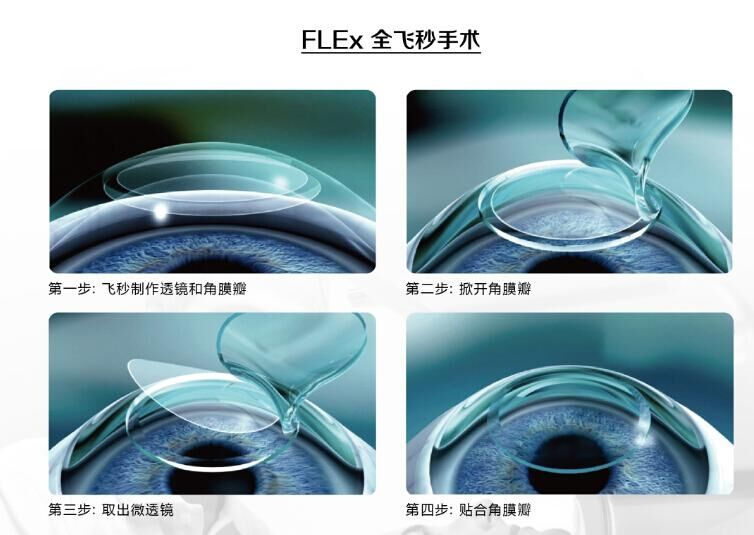 蔡司全飛秒、蔡司半飛秒近視手術(shù)與蔡司全飛秒flex手術(shù)