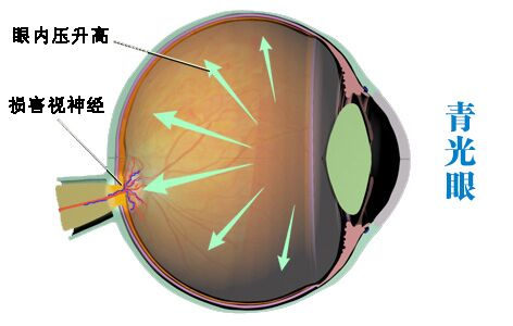 控制青光眼預(yù)防致盲的10大要點(diǎn)
