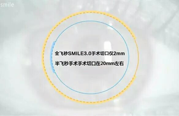 重磅發(fā)布：全飛秒SMILE3.0智能升級