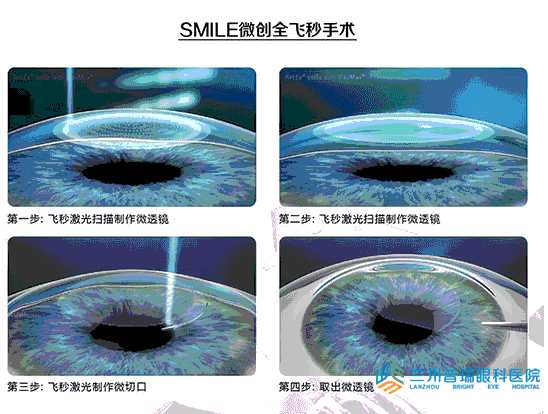 蘭州全飛秒激光近視手術(shù)無瓣(smile)技術(shù)