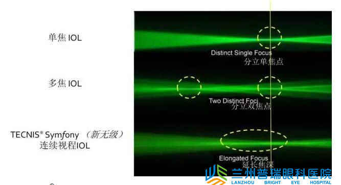 蘭州眼科醫(yī)院成功實施新無極變焦晶體植入術