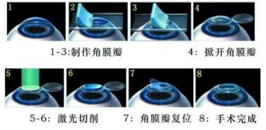 準(zhǔn)分子激光手術(shù)到底是怎么治 愈你的眼睛的？