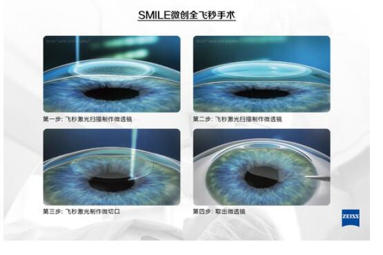 準(zhǔn)分子激光手術(shù)到底是怎么治 愈你的眼睛的？