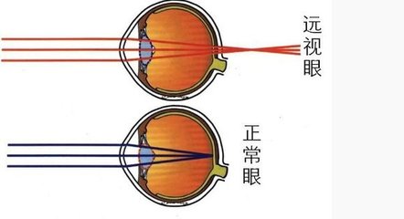 造成遠(yuǎn)視眼的病因病理