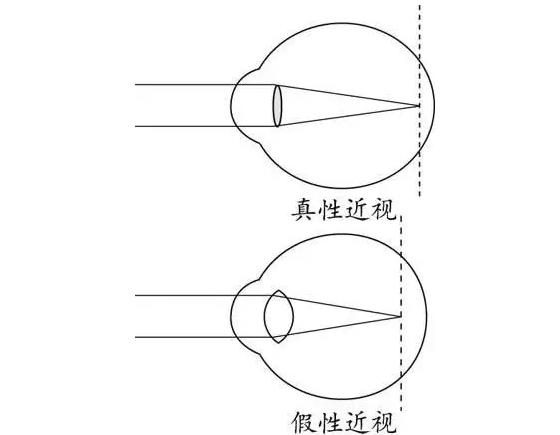 醫(yī)學(xué)小方法：檢測真性近視還是假性近視