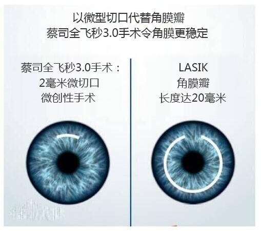 近視手術(shù)有哪幾種？你適合那種快看看